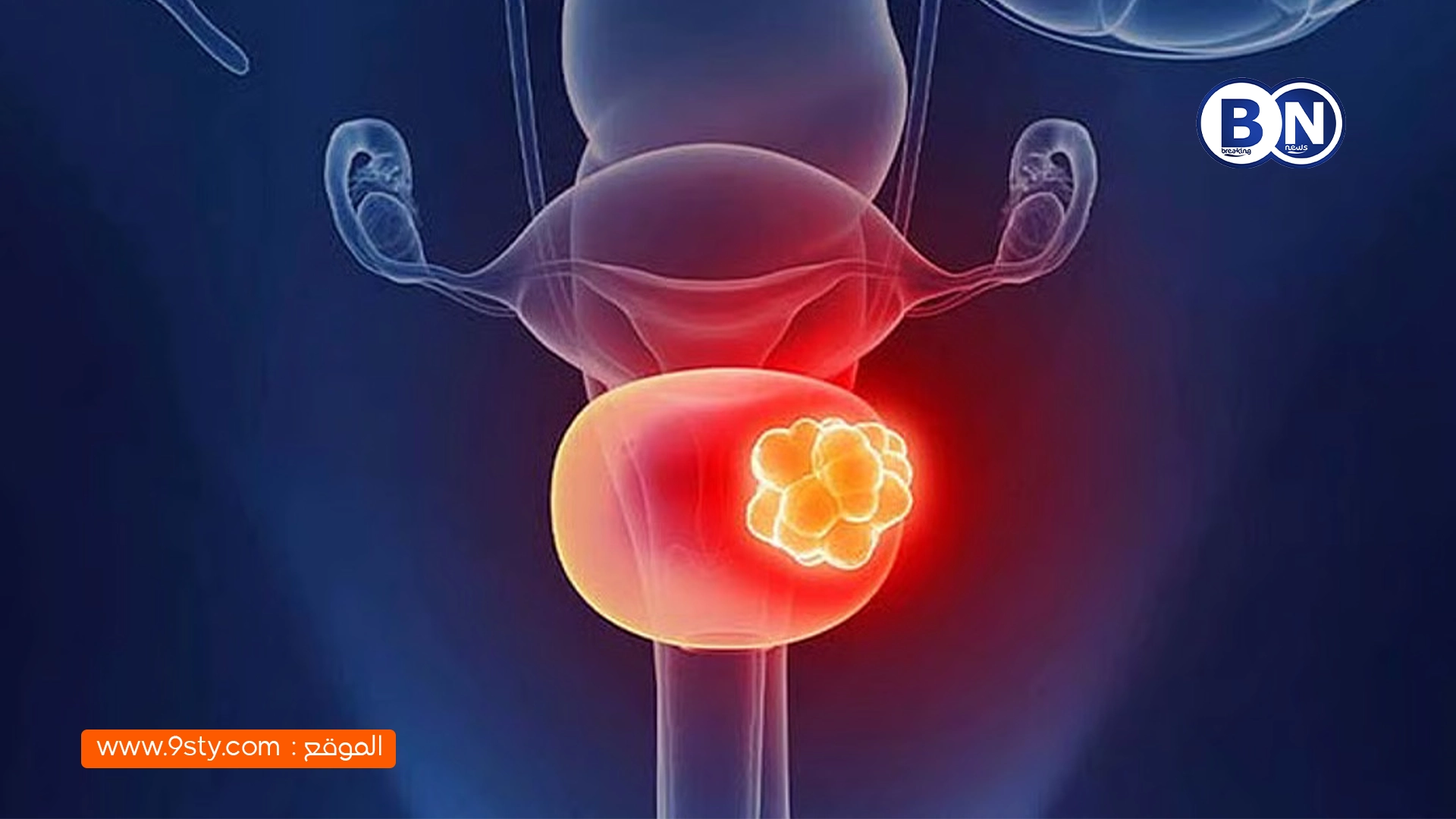 علاج جديد يقضي تمامًا على أورام المثانة لدى 82٪ من المرضى في تجربة دولية